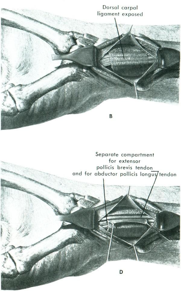 M. de Quervain Discise šlachové pochvy m.