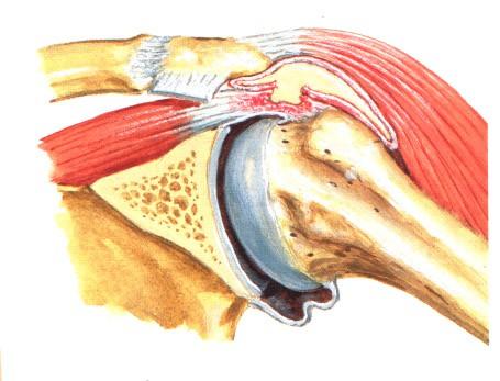 Bursitis subacromialis Zánět burzy Tekutina Event.