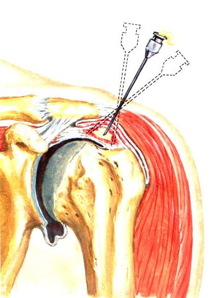 Bursitis subacromialis Konzerativní léčba: Klid, závěs proplach metodou dvou jehel