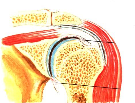 Příčiny syndromu zmrzlého ramene Všechny stavu omezující pohyb: Impingement syndrom Arthróza AC Arthróza sternoklavikulární Stavy po úrazech