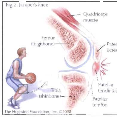 . JUMPER'S KNEE Jumper's knee je tennín označující entezopatii v oblasti proximálního úponu lig. patellae a distálního pólu pately.