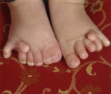 Na nohou se prsty separují zcela výjimečně z kosmetických důvodů. - polydaktylie Patří k častým vrozeným vadám končetin (1:3000). Často jsou spojeny s dalšími systémovými vadami (orgánová postižení).