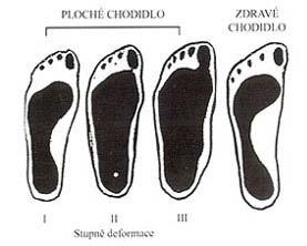 Klinicky lze rozdělit plochou nohu podle stavu vady na: I. stupeň (pokles klenby někdy s valgózním postavením paty, deformitu lze aktivně korigovat, nejsou bolesti) II.