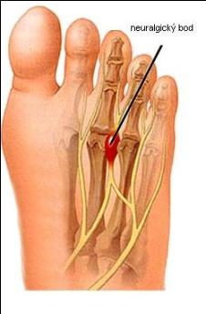 Fixovaná příčně plochá noha má příčnou klenbu trvale oploštěnou, často s vyčnívajícími hlavičkami druhého a třetího prstu do plosky nohy.