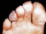 Ulcerace se vyskytují nejčastěji pod prsty, hlavičkami prstních kloubů (metatarzů) a pod patou. Příčinou ulcerací je v mnoha případech nevhodná obuv.