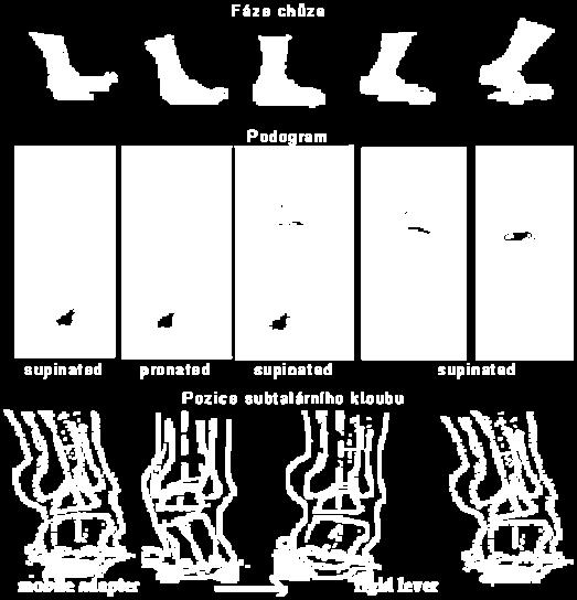 5-5 Jednotlivé fáze chůze na podoskopu a pozice subtalárního kloubu při jednotlivých fázích chůze Při došlapu působí na nohu kromě vertikální zátěže i síly smykové a torzní.