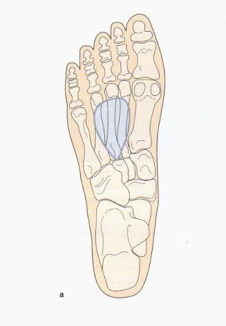6.3 Modifikace individuálních vložek při řešení vad nohou Konstrukce vložky musí být upravována na základě zjištěného postižení.