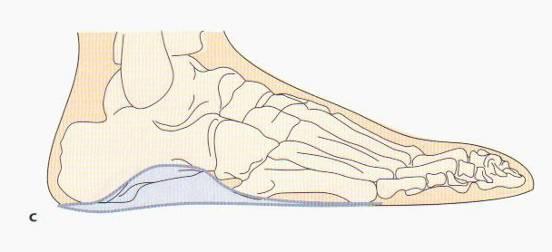 6-12 Úprava pro Pes vagus - Dětský pes planovalgus