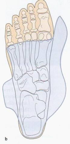 6-16 Úprava pro kosovitou nohu Další část vychází z Orthopädie Schuhtechnik für Podologen 34 - Opěrné vložky k odlehčení