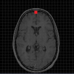(A) (B) Obrázek 11: Korekce pohybu, (A) před korekcí, (B) po korekci Korekce rozdílných akvizičních časů jednotlivých řezů Typická pulzní sekvence pro nasnímání celého mozku obsahuje 24 řezů (možno i