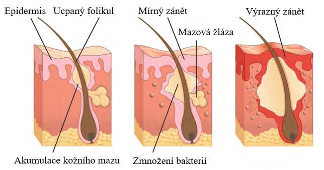 Propionibacterium acnes je hlavní zástupce bakteriální flóry, která se uplatňuje až v průběhu onemocnění.