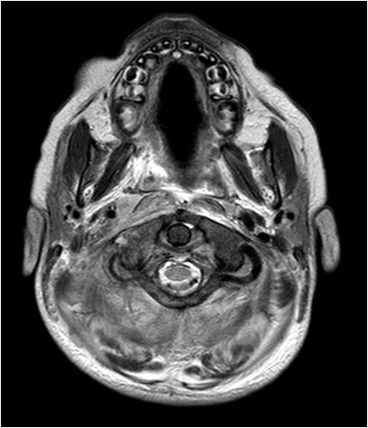 Brain CT scan: Mastoiditis empyema around cerebellar hemisphere both