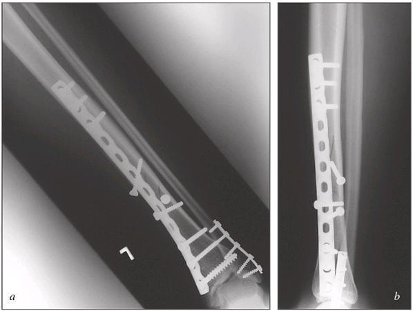 výhodné vlastnosti oproti klasickým konvenčním dlahám. Z biomechanického hlediska je rozložení sil přenášených ze šroubů na kost u LCP dlah odlišné.