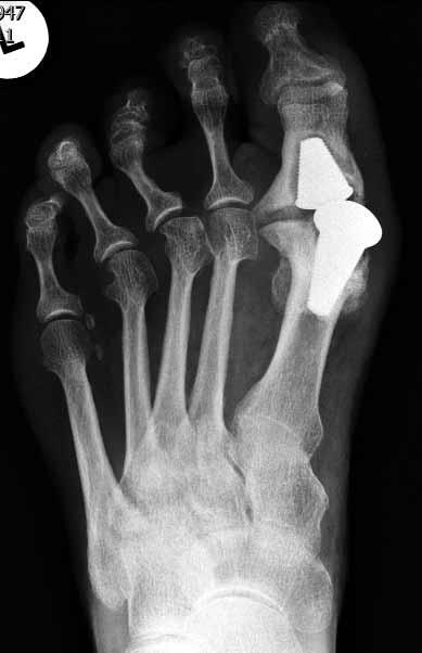460/ Acta Chir Orthop Traumatol Cech. 84, 2017, No. 6 PŮVODNÍ PRÁCE 36 37 38 Obr. 36, 37, 38. Žena *1947, selhání TEP Toefit z r. 2007, explantace TEP a artrodéza v r. 2012, po zhojení extrakce dlahy.