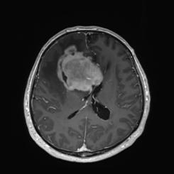 MRI 18.12.2017 Multifokální mozkový tumor Nevětší frontálně vpravo vel.