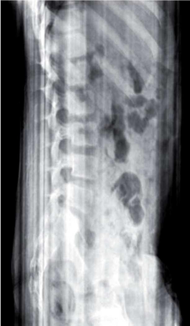 porušený datový kabel laterální snímek bederní páteře ukazuje střídající se tmavé linky, které komplikují čtení detailů
