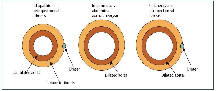 Ormond disease characterized by fibroinflammatory tissue surrounding the