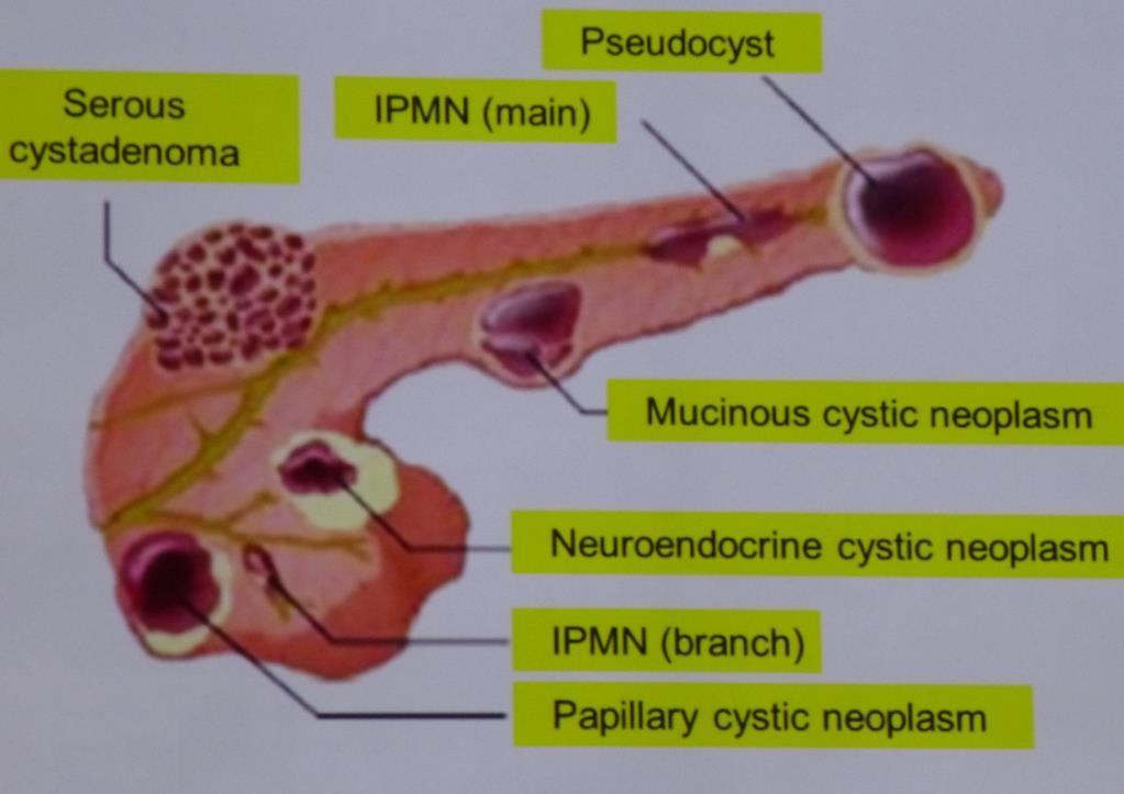 Rozložení cystických nádorů pankreatu z hlediska věku a pohlaví
