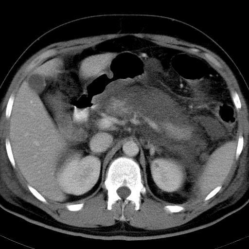 Akutní pankreatitida - CT CT