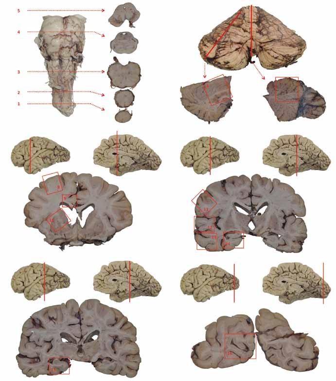 5 4 Tab. 1. Základní struktury potřebné pro diferenciální diagnostiku neurodegenerací a jejich kombinací. 3 2 1 1. bederní, hrudní a krční míšní segmenty 2. prodloužená mícha 3.