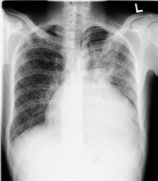 Problematika tuberkulózy a latentní tuberkulózní infekce u pa cientů s idiopatickými Hereditárny střevními angioedém záněty léčenými ako príčina bio logickou bolestí brucha léčbou Obr. 1.
