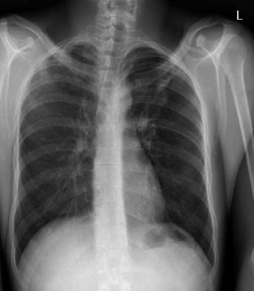 A 25-year-old patient with lung, pericardial and urogenital tract tuberculosis before initiating anti-tuberculosis therapy.