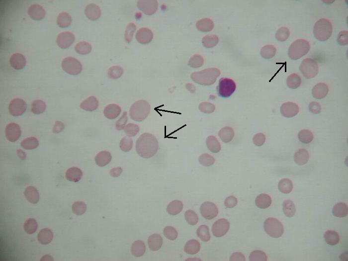 a hemoglobinopatie C a E, dále u získaných poruch tvorby hemoglobinu, ale i některé chronické anémie. Makrocyt je erytrocyt s vetší velikostí. Makrocyt má průměr větší neţ 8,5 µm a objem nad 98 fl.
