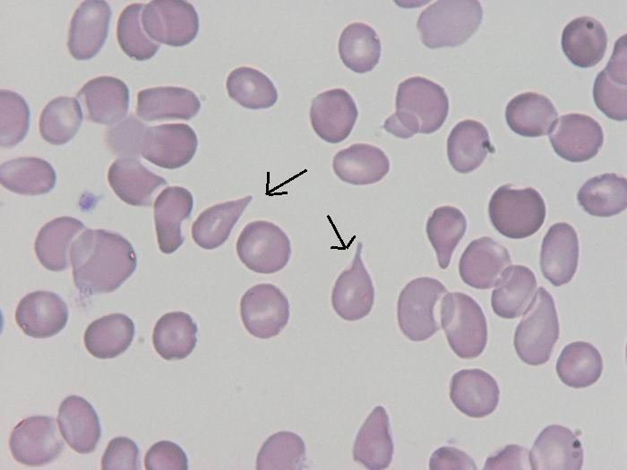 Jejich nález je významný pro diagnostiku myelofibrózy, myeloidní metaplazie, perniciozní anemie, talasemie atd. Obrázek č.