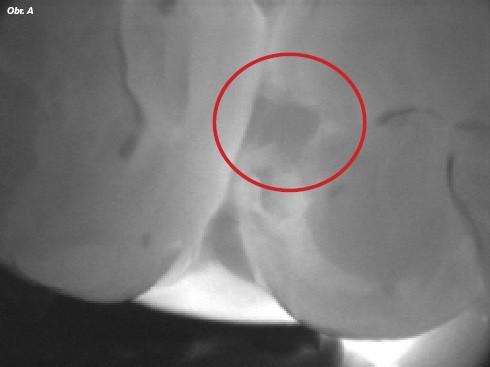 Pomocí RTG zjistíme stav, typ a rozsah poškození TZT ( možnost remineralizace) Diagnodent laserový přístroj - ztráta minerálů ve fisurách a na dostupných plochách zubů DIAGNOCam se skládá z CCD