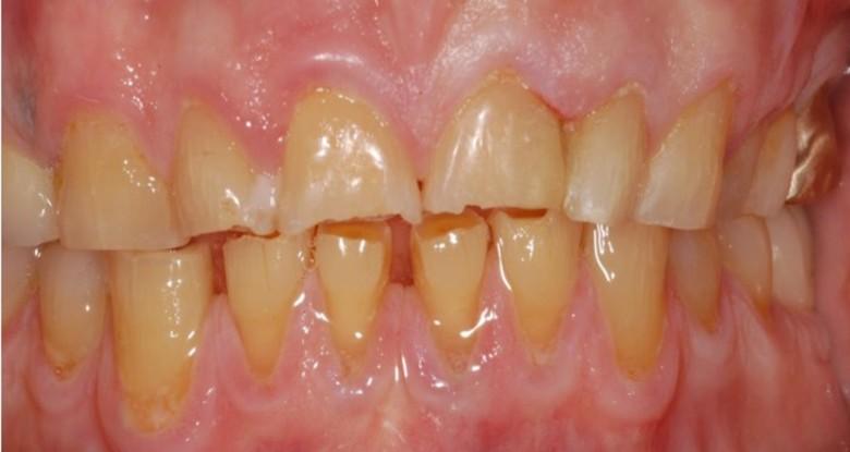 Atrice je pomalá ztráta zubních tkání vzniklá přímým kontaktem antagonních zubů nebo sousedících ploch zubů. Nejčastěji postižené plochy jsou okluzní a incizní, následovány aproximálními prostory.