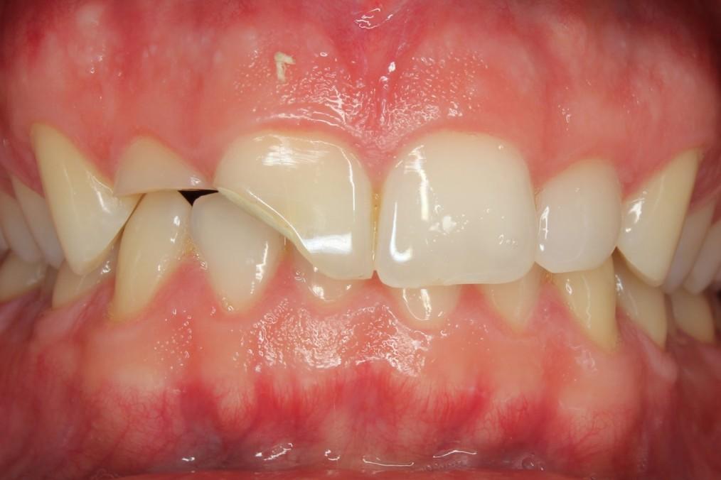 Zlomeninu zubu stanovíme u pacienta, u kterého zjistíme odchylku tvaru zubu způsobenou mechanickým poškozením.
