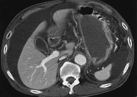 supramesocolica Recessus subph.dx.