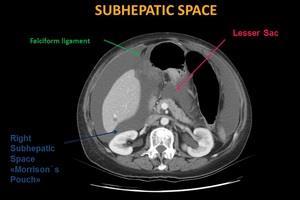 subhepatici Recessus subhepaticus dx.