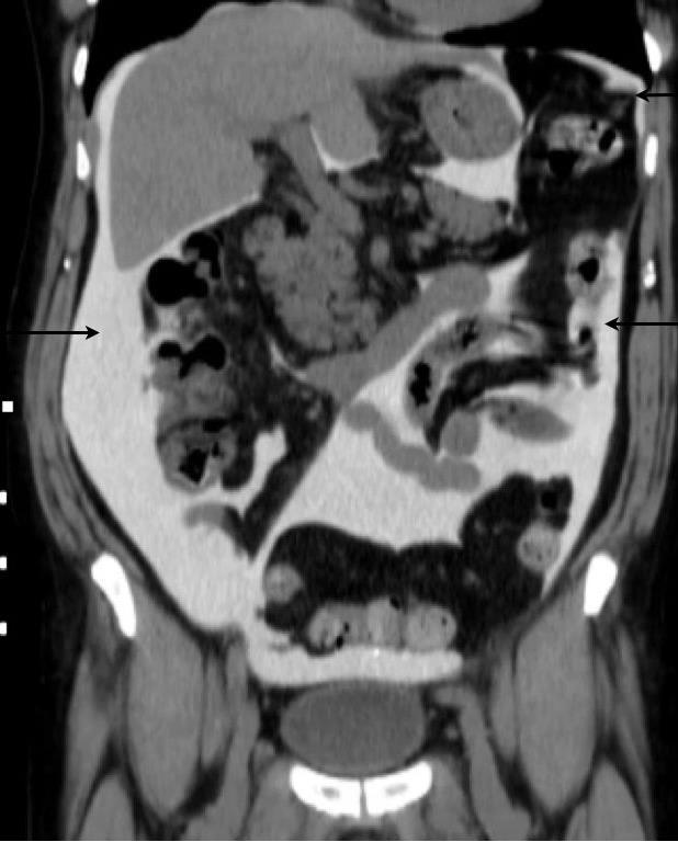 Peritoneal Anatomy - A