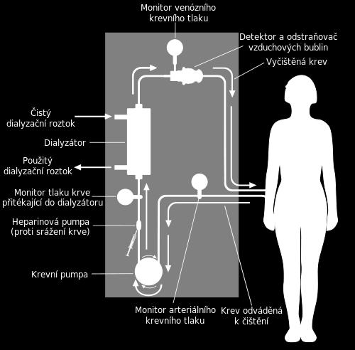 Na obrázku je znázorněn princip hemodialýzy. Pacient se napojí na mimotělní okruh, který zajišťuje cirkulaci krve přes dialyzátor (označováno jako dialyzační kapilára ).