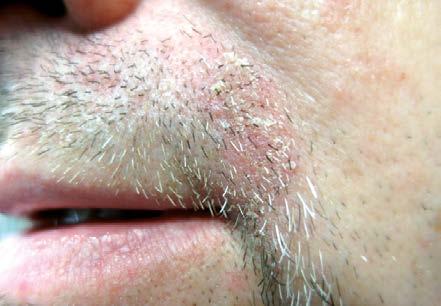 e15 Obrázek 1. Dermatitis seborrhoica faciei Obrázek 2. Dermatitis seborrhoica palpebrae ostře ohraničených ložisek, postihujících různá místa těla. Formu plně rozvinutou reprezentuje tzv.