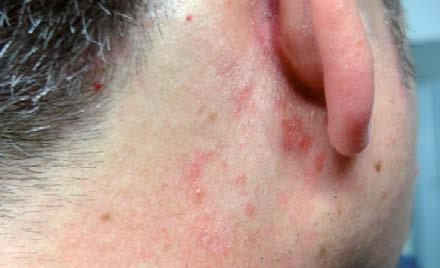 e16 Obrázek 3. Dermatitis seborrhoica retroauricularis Obrázek 4. Dermatitis seborrhoica mediothoracica prsy a v okolí pupku.