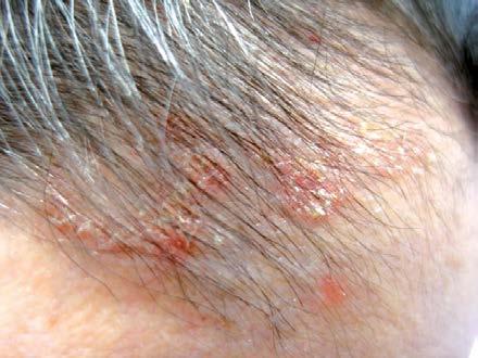 e17 Obrázek 5. Dermatitis seborrhoica capilitií Obrázek 6.