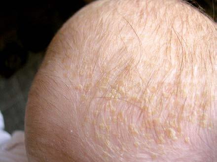 rozlišit SD od atopické dermatitidy v kojeneckém věku (tabulka 1 dle Benákové). U batolat a dětí předškolního a školního věku odlišujeme frustní formu atopické dermatitidy, tzv.