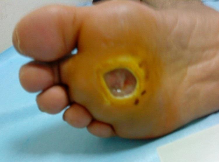 CACIPLIQ Klinické případy: diabetický vřed na noze Před léčbou CACIPLIQ20 po 7 dnech CACIPLIQ2 po 72 dnech Vřed stagnující po dobu 6 měsíců