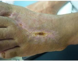 CACIPLIQ Klinické případy: diabetický a neuropatický vřed po