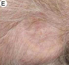 CACIPLIQ Klinické případy: rána
