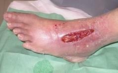 diabetickým vředem léčený