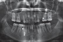 Kazuistika Implantace pomocí dynamické navigace s okamžitým zatížením Autor: Dr. Jan D haese, Dr. Johan Ackhurst & Prof. Hugo De Bruyn Obr. 1a Obr. 1a, 1b: NaviStent chirurgická dlaha Obr.