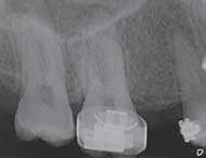 Pacientka byla v dobrém celkovém zdravotním stavu a nekuřačka. Dříve byla léčena na ortodontickém oddělení Univerzitní nemocnice v Gentu pro mnohočetné ageneze zubů.
