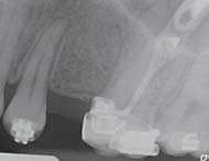 Parodontologické vyšetření neprokázalo žádné známky patologie. Minišrouby pro skeletální kotvení během ortodontické léčby byly stále přítomny ve druhém a čtvrtém kvadrantu.
