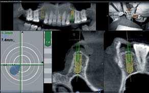 V regio 15 byl zaveden implantát o délce 13 mm a průměru 4 mm v průměru, zatímco v regio 25 implantát o délce 10 mm a průměru