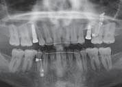 Kazuistika Implantace pomocí dynamické navigace s okamžitým zatížením Obr. 12 Obr. 13 Obr. 14 Obr. 15 Obr. 16a Obr. 16b Obr.