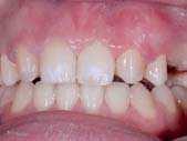 be Po zavedení zubních implantátů bylo provedeno prodloužení korunek ve frontálním úseku horní čelisti za účelem zlepšení estetického výsledku.