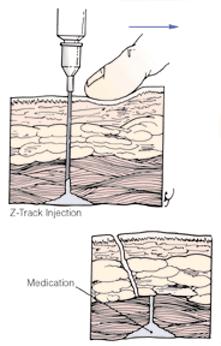 i.m. injekce Z - track aplikace léků silně dráždivých pro podkoží a kůži malá vzduchová